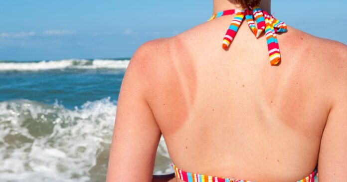 Does Your Sunburn Require Medical Attention? Here Are The 2 Signs It Does.